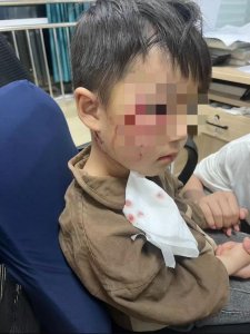 ​新闻多一度｜3岁男童被狗咬伤去世 接种狂犬疫苗为何还会病发？