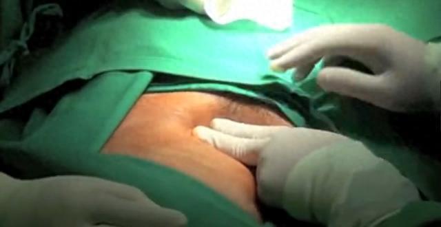 实录女性结扎全经过