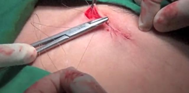 实录女性结扎全经过